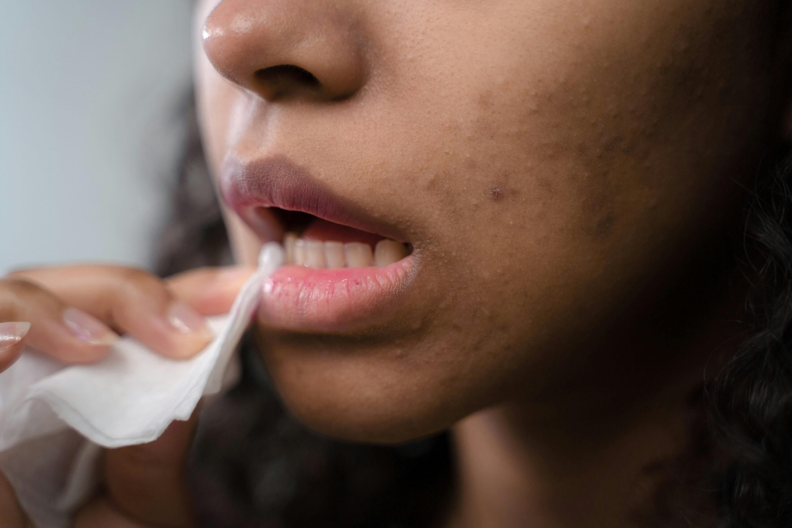 Person with acne scars Person with acne scars wipes their lip with a wet wipe